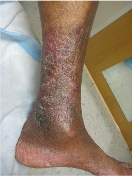 picture of dark skinned Skin changes ascribed to venous disease