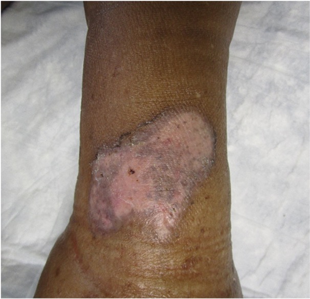 picture of dark skinned Healed venous ulcer
