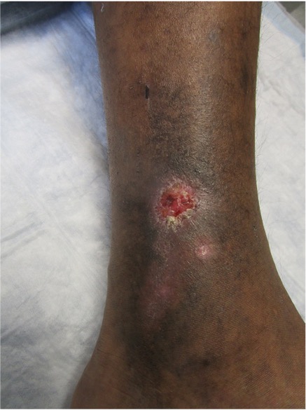 picture of dark skinned Active venous ulcer or recurrent venous ulceration
