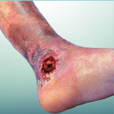 picture of Active venous ulcer or recurrent venous ulceration